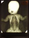 Vorschau Röntgenbild, Mikromyelie beim neugeborenen Kind